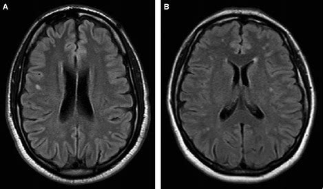 White matter lesions and migraine. Typical brain MRI images showing... | Download Scientific Diagram