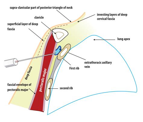 Axillary Vein Access Cross Section Schematic – How to Pace