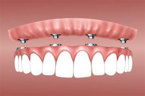 Dental Implant Procedure: What You Need To Know – Gordon Dental