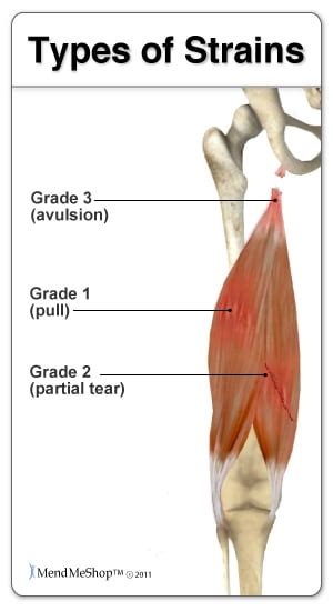 Grades of Hamstring Pulls