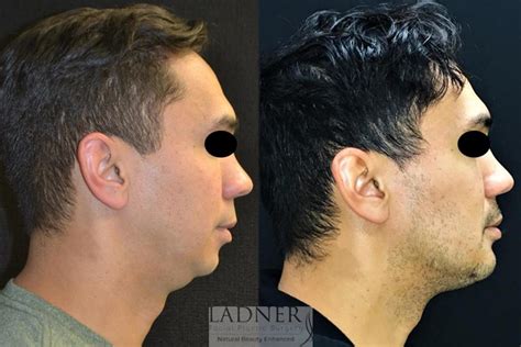 Chin Augmentation / Buccal Fat Removal Before and After Pictures Case 67 | Denver, CO | Ladner ...