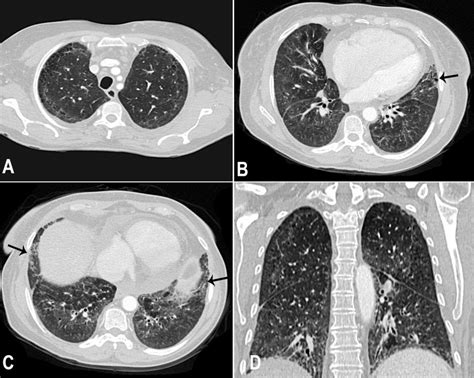 Emphysema Lung Ct Scan