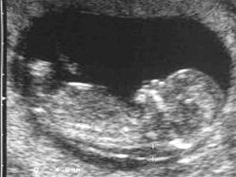 Fig. Fetal Down syndrome with measurement of nuchal translucency... | Download Scientific Diagram