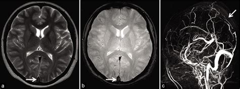 Pearls and Pitfalls in the Magnetic Resonance Diagnosis of Dural Sinus ...