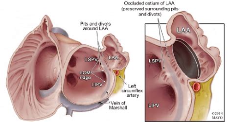 Relevant Anatomy Surrounding the Left Atrial Appendage Illustration of... | Download Scientific ...