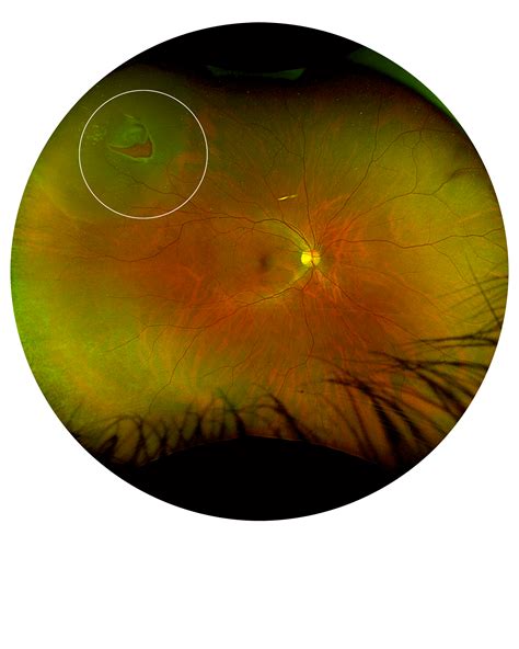 Retinal Tears Causes & Surgery | Eduardo Besser, MD