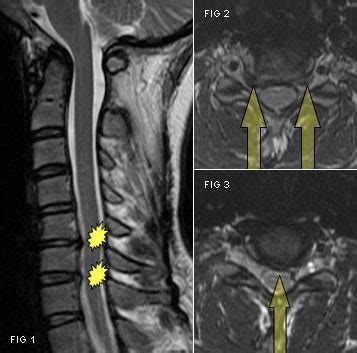 Herniated Disc - Vancouver Spine Doctor