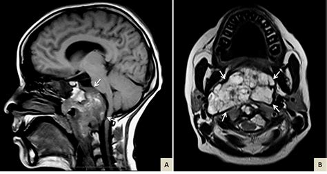 Clival Chondroid Chordoma: A Case Report and Review of the Literature ...