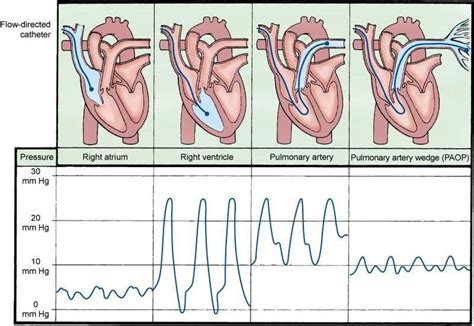 Hemodynamic Monitoring Flashcards | Chegg.com | Cath lab nursing, Icu ...