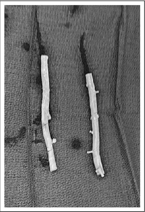 Figure 3 from Management and Outcome of Prosthetic Vascular Graft ...