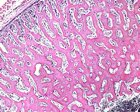 Woven Bone Vs Lamellar Bone