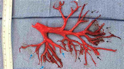 Man coughs up a massive, intact blood clot shaped perfectly like his lung passages – Firstpost