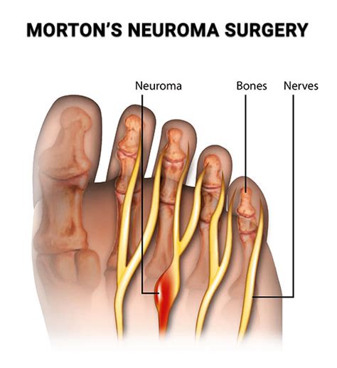 Morton's Neuroma Specialist - Clifton, NJ: Premier Podiatry: Velimir Petkov, DPM: Podiatrist