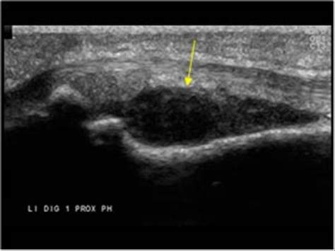 Musculoskeletal Joints and Tendons | 6.4 Fingers : Case 6.4.5 Tumors | Ultrasound Cases