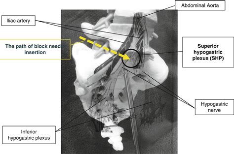 Hypogastric Plexus Block - Technique and Overview - The Procedure Guide