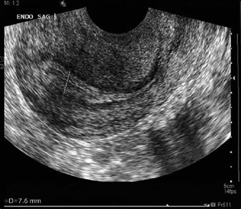 Pregnancy Of Unknown Location - Solving the Dilemmas of PUL Pregnancy ...