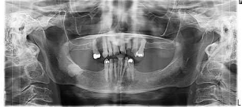 Pathology Outlines - Condensing osteitis