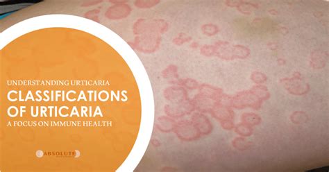 Classifications of Urticaria | Dr Johann de Chickera ND