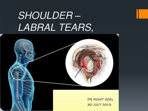 What Does A Shoulder Labral Tear Look Like On Mri - Printable Templates Free