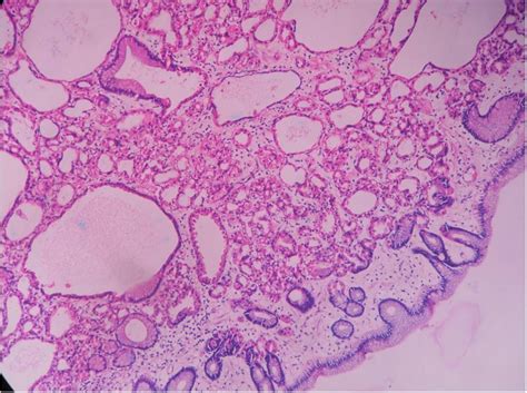 Fundic gland polyp – Histopathology.guru