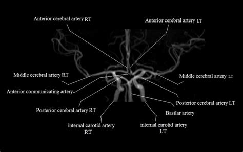 brain arteries | MRA brain arteries anatomy | Arteries anatomy, Circle ...