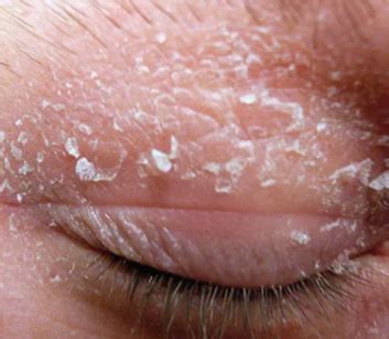 Dry skin on eyelid can be caused by many factors such as allergies ...