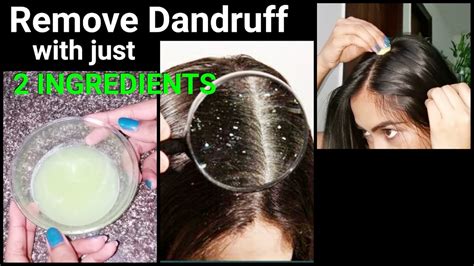 Magical Home Remedy to Remove DANDRUFF at home//Dandruff treatment/How ...