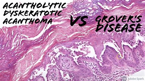 Acantholytic Dyskeratotic Acanthoma vs Grover's Disease: 5-Minute ...