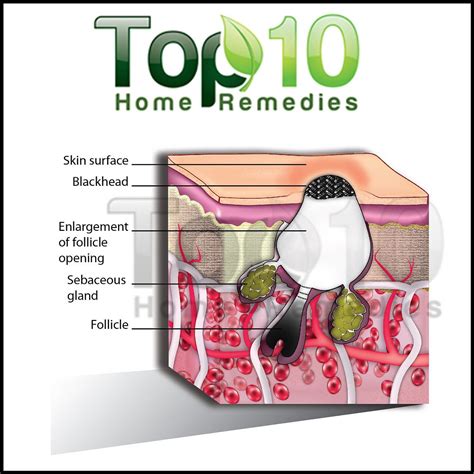 Home Remedies for Blackheads | Top 10 Home Remedies