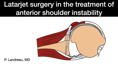 Latarjet surgical procedure in the treatment of anterior shoulder instability - YouTube