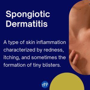 Spongiotic Dermatitis: Causes, Treatments, and Prevention Measures