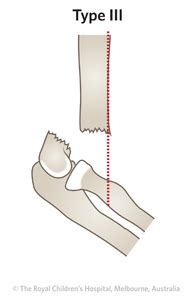 Clinical Practice Guidelines : Supracondylar fracture of the humerus - Fracture clinics