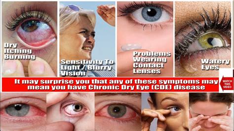 DRY EYE SYNDROME | GUJARATI | ગુજરાતી | Patient Education & Information | Causes,Symptoms ...