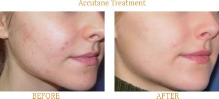 Acne Treatment New York, NY - Adult Acne | Dr. Stephen Comite