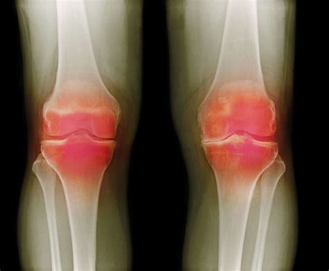 What Does Arthritis Look Like?