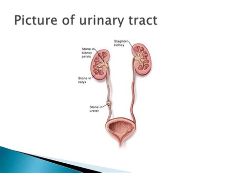 Ureteric colic | PPT