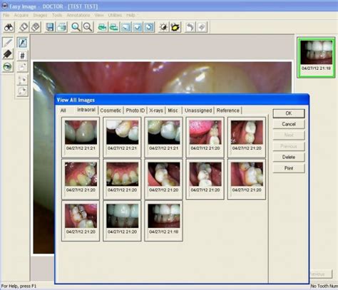 Intraoral Camera Step by Step Easy Dental Intraoral Camera Integration | Lensiora