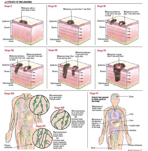 Staging Melanoma - SITC connectED