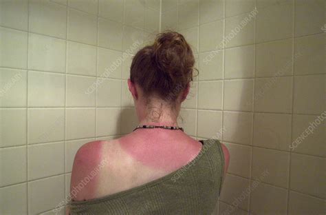 Sunburnt back - Stock Image - M335/0177 - Science Photo Library