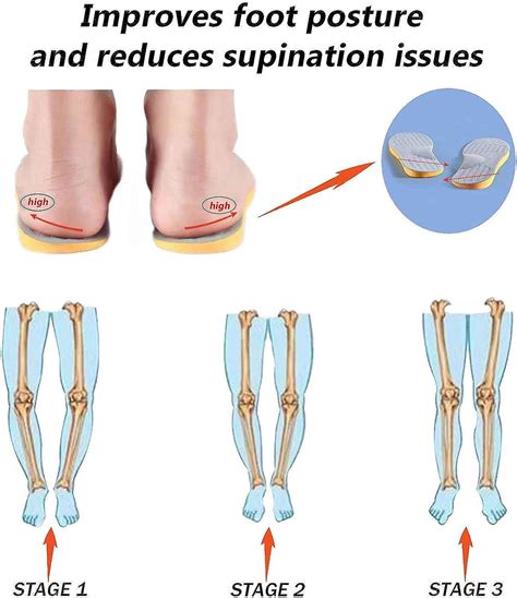 Supination Insoles For Over Supination & High Arch Support,orthotic ...