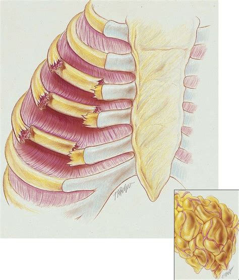 Flail Chest | Clinical Gate