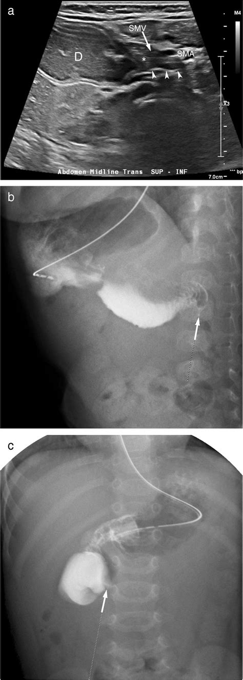 Duodenal web in a 5-month-old boy. a A transverse US image at the level... | Download Scientific ...