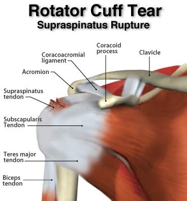 Supraspinatus Tear - Ohio Therapy Centers - Northeast Ohio