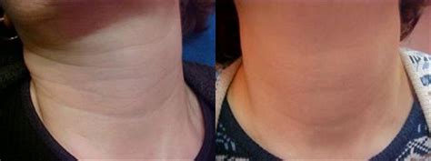 Neck and chin treatments - Castleknock Cosmetic Clinic