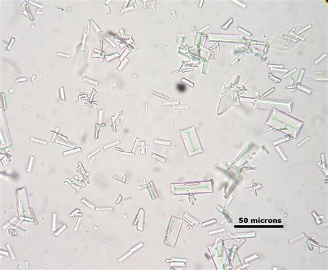 Calcium Oxalate Dihydrate Crystals In Urine