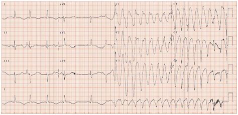 Polymorphic Ventricular Tachycardia Ecg