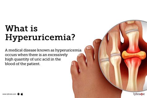 Hyperuricemia: Causes, Symptoms, Treatment and Cost