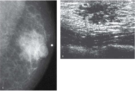 Male Gynecomastia Ultrasound