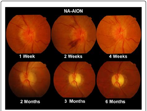 Progression of Optic Nerve changes in NA-AION from initial hyperaemia... | Download Scientific ...