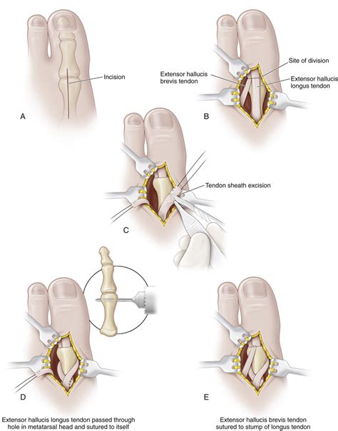 20 Split Anterior Tibialis Tendon Transfer | Musculoskeletal Key